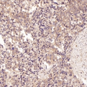IHC staining of FFPE human prostate cancer tissue with BCL2L11 antibody. HIER: boil tissue sections in pH6, 10mM citrate buffer, for 10-20 min and allow to cool before testing.