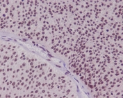 IHC staining of FFPE human bladder carcinoma with FOXO3A antibody. HIER: boil tissue sections in pH6, 10mM citrate buffer, for 10-20 min and allow to cool before testing.