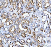 IHC staining of FFPE human prostate cancer tissue with JAK2 antibody. HIER: boil tissue sections in pH8 EDTA for 20 min and allow to cool before testing.