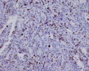IHC staining of FFPE human ovarian cancer with BIRC5 antibody. HIER: boil tissue sections in pH6, 10mM citrate buffer, for 10-20 min and allow to cool before testing.
