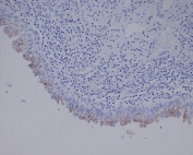 IHC staining of FFPE human bladder cancer tissue with Uroplakin III antibody. HIER: boil tissue sections in pH6, 10mM citrate buffer, for 10-20 min and allow to cool before testing.