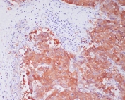 IHC staining of FFPE human liver cancer with ALDH1A1 antibody. HIER: boil tissue sections in pH6, 10mM citrate buffer, for 10-20 min and allow to cool before testing.