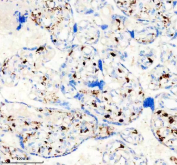 IHC staining of FFPE human placental tissue with Factor XIIIa antibody, HRP-secondary and DAB substrate. HIER: boil tissue sections in pH8 EDTA for 20 min and allow to cool before testing.