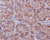 IHC staining of FFPE human stomach cancer with EGFR antibody. HIER: boil tissue sections in pH6, 10mM citrate buffer, for 10-20 min and allow to cool before testing.