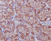 IHC staining of FFPE human stomach cancer with EGFR antibody. HIER: boil tissue sections in pH6, 10mM citrate buffer, for 10-20 min and allow to cool before testing.