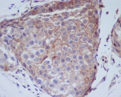IHC staining of FFPE human breast cancer with phospho-EGFR antibody. HIER: boil tissue sections in pH6, 10mM citrate buffer, for 10-20 min and allow to cool before testing.