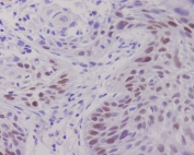 IHC staining of FFPE human lung cancer with c-Myc antibody. HIER: boil tissue sections in pH6, 10mM citrate buffer, for 10-20 min and allow to cool before testing.