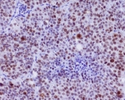 IHC staining of FFPE human lung carcinoma with c-Myc antibody. HIER: boil tissue sections in pH6, 10mM citrate buffer, for 10-20 min and allow to cool before testing.
