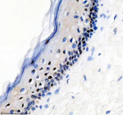 Immunohistochemical staining of FFPE human skin cancer tissue with phospho-c-Myc antibody, HRP-secondary and DAB substrate. HIER: boil tissue sections in pH8 EDTA for 20 min and allow to cool before testing.