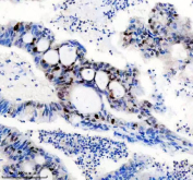 Immunohistochemical staining of FFPE human colon cancer tissue with phospho-c-Myc antibody, HRP-secondary and DAB substrate. HIER: boil tissue sections in pH8 EDTA for 20 min and allow to cool before testing.