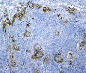 IHC staining of FFPE human lung cancer with SLC34A2 antibody. HIER: boil tissue sections in pH6, 10mM citrate buffer, for 10-20 min and allow to cool before testing.