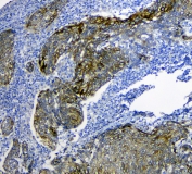 IHC staining of FFPE human lung cancer with SLC34A2 antibody. HIER: boil tissue sections in pH6, 10mM citrate buffer, for 10-20 min and allow to cool before testing.