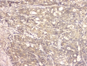 IHC staining of FFPE human stomach cancer with BMP15 antibody at 1ug/ml. HIER: boil tissue sections in pH6, 10mM citrate buffer, for 10-20 min and allow to cool before testing.