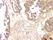 IHC staining of FFPE human ovarian cancer with BMP15 antibody at 1ug/ml. HIER: boil tissue sections in pH6, 10mM citrate buffer, for 10-20 min and allow to cool before testing.