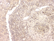 IHC staining of FFPE human lung cancer with BMP15 antibody at 1ug/ml. HIER: boil tissue sections in pH6, 10mM citrate buffer, for 10-20 min and allow to cool before testing.