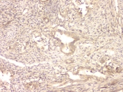 IHC staining of FFPE human intestinal cancer with BMP15 antibody at 1ug/ml. HIER: boil tissue sections in pH6, 10mM citrate buffer, for 10-20 min and allow to cool before testing.