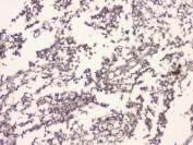 IHC staining of FFPE human glioma with APP antibody at 1ug/ml. HIER: boil tissue sections in pH6, 10mM citrate buffer, for 10-20 min and allow to cool before testing.