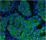 Immunofluorescent staining of FFPE human breast cancer with Keratin 8 antibody (green) and DAPI nuclear stain (blue). HIER: steam section in pH8 EDTA for 20 min.
