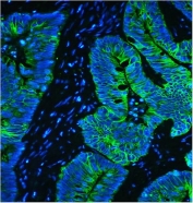 Immunofluorescent staining of FFPE human intestinal cancer with Keratin 8 antibody (green) and DAPI nuclear stain (blue). HIER: steam section in pH8 EDTA for 20 min.