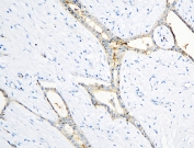 IHC staining of FFPE human breast cancer with Annexin A3 antibody at 1ug/ml. HIER: boil tissue sections in pH6, 10mM citrate buffer, for 10-20 min and allow to cool before testing.
