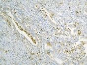 IHC staining of FFPE human intestinal cancer with Annexin A3 antibody at 1ug/ml. HIER: boil tissue sections in pH6, 10mM citrate buffer, for 10-20 min and allow to cool before testing.