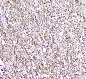 IHC staining of FFPE human lymphocytic tumor with L Plastin antibody at 1ug/ml. HIER: boil tissue sections in pH6, 10mM citrate buffer, for 10-20 min and allow to cool before testing.