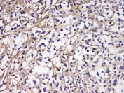 IHC staining of FFPE human lymphocytic tumor with IGLL1 antibody at 1ug/ml. HIER: boil tissue sections in pH6, 10mM citrate buffer, for 10-20 min and allow to cool before testing.