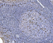 IHC staining of FFPE human tonsil tissue with CHM antibody. HIER: boil tissue sections in pH8 EDTA for 20 min and allow to cool before testing.