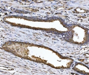 IHC staining of FFPE human prostate cancer tissue with CHM antibody. HIER: boil tissue sections in pH8 EDTA for 20 min and allow to cool before testing.