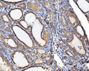 IHC staining of FFPE human thyroid cancer tissue with CHM antibody. HIER: boil tissue sections in pH8 EDTA for 20 min and allow to cool before testing.
