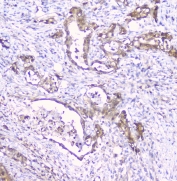 IHC staining of FFPE human intestinal cancer with CDA antibody at 1ug/ml. HIER: boil tissue sections in pH6, 10mM citrate buffer, for 10-20 min and allow to cool before testing.