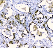 IHC staining of FFPE human lung cancer with CDA antibody at 1ug/ml. HIER: boil tissue sections in pH6, 10mM citrate buffer, for 10-20 min and allow to cool before testing.