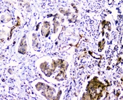 IHC staining of FFPE human breast cancer with CDA antibody at 1ug/ml. HIER: boil tissue sections in pH6, 10mM citrate buffer, for 10-20 min and allow to cool before testing.
