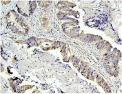 IHC staining of FFPE human intestinal cancer with Caspase 3 antibody. HIER: boil tissue sections in pH8 EDTA for 20 min and allow to cool before testing.