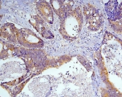 IHC staining of FFPE human intestinal cancer with Caspase 3 antibody. HIER: boil tissue sections in pH8 EDTA for 20 min and allow to cool before testing.