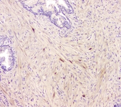 IHC staining of FFPE human prostate cancer with CCR10 antibody at 1ug/ml. HIER: boil tissue sections in pH6, 10mM citrate buffer, for 10-20 min and allow to cool before testing.