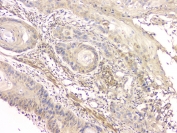 IHC staining of FFPE human esophageal squamous cancer with CCR10 antibody at 1ug/ml. HIER: boil tissue sections in pH6, 10mM citrate buffer, for 10-20 min and allow to cool before testing.