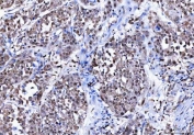 IHC staining of FFPE human lung cancer tissue with BAG6 antibody. HIER: boil tissue sections in pH8 EDTA for 20 min and allow to cool before testing.