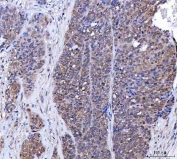 IHC staining of FFPE human ovarian serous adenocarcinoma tissue with BAG6 antibody. HIER: boil tissue sections in pH8 EDTA for 20 min and allow to cool before testing.