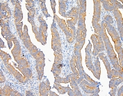 IHC staining of FFPE human intestinal cancer with IQGAP1 antibody at 1ug/ml. HIER: boil tissue sections in pH6, 10mM citrate buffer, for 10-20 min and allow to cool before testing.