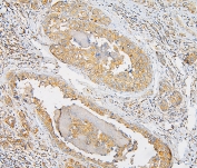 IHC staining of FFPE human breast cancer with IQGAP1 antibody at 1ug/ml. HIER: boil tissue sections in pH6, 10mM citrate buffer, for 10-20 min and allow to cool before testing.