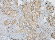 IHC staining of FFPE human breast cancer with IQGAP1 antibody at 1ug/ml. HIER: boil tissue sections in pH6, 10mM citrate buffer, for 10-20 min and allow to cool before testing.