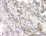IHC staining of FFPE human renal cancer with RHOB antibody. HIER: boil tissue sections in pH6, 10mM citrate buffer, for 20 min and allow to cool before testing.