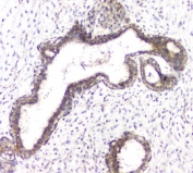 IHC staining of FFPE human breast cancer with RHOB antibody. HIER: boil tissue sections in pH6, 10mM citrate buffer, for 20 min and allow to cool before testing.