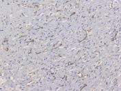 IHC staining of FFPE human breast cancer with TEK antibody at 1ug/ml. HIER: boil tissue sections in pH6, 10mM citrate buffer, for 10-20 min and allow to cool before testing.
