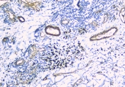 IHC staining of FFPE human lung cancer with TEK antibody at 1ug/ml. HIER: boil tissue sections in pH6, 10mM citrate buffer, for 10-20 min and allow to cool before testing.
