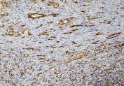IHC staining of FFPE human melanoma with Caveolin-1antibody. HIER: boil tissue sections in pH8 EDTA for 20 min and allow to cool before testing.