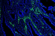 Immunofluorescent staining of FFPE human colorectal cancer tissue with Caveolin-1 antibody (green) and DAPI nuclear stain (blue). HIER: steam section in pH6 citrate buffer for 20 min.