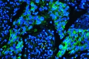 Immunofluorescent staining of FFPE human lung cancer tissue with Caveolin-1 antibody (green) and DAPI nuclear stain (blue). HIER: steam section in pH6 citrate buffer for 20 min.