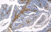 IHC staining of FFPE human intestinal cancer with Caveolin-1antibody. HIER: boil tissue sections in pH8 EDTA for 20 min and allow to cool before testing.